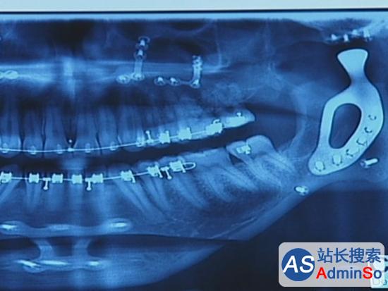 澳洲第一位植入3D打印下巴的男人