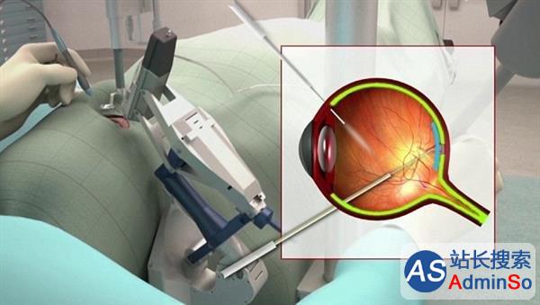 全球首例机器人视网膜手术成功进行：比人靠谱